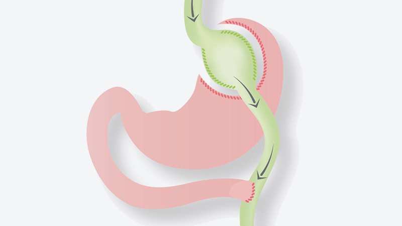Gastric Bypass Surgery Gastric Bypass Surgery