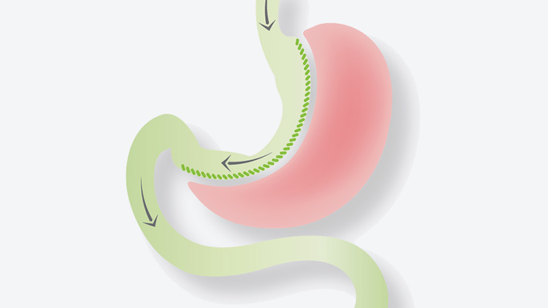Sleeve Gastrectomy Sleeve Gastrectomy